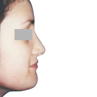 After Lifting the tip of the nose