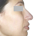 Before Lifting the tip of the nose