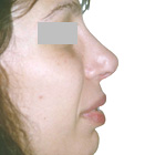 After Lifting the tip of the nose