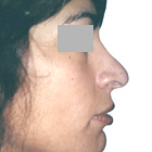 Before Lifting the tip of the nose