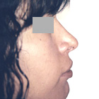 After Lifting the tip of the nose