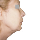 Before Facelift