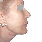 After Facelift