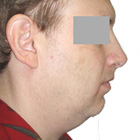 Before Facelift