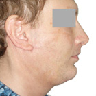 After Facelift