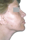 After Facelift