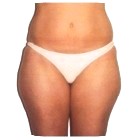 Before Liposuction