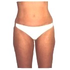 After Liposuction