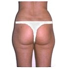 Before Liposuction