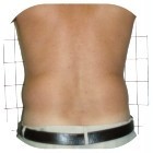 Before Liposuction