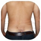 After Liposuction