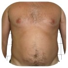 Before Liposuction