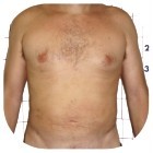 After Liposuction