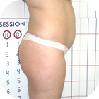 Before Liposuction
