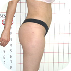 After Liposuction