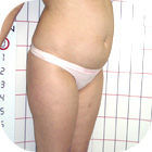 Before Liposuction