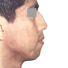 Before Lifting the tip of the nose