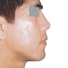 After Lifting the tip of the nose