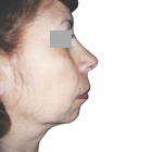Before Facelift