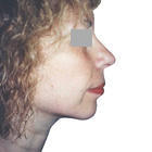 After Facelift