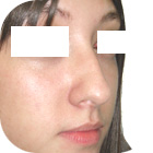 Before Lifting the tip of the nose