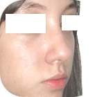 After Lifting the tip of the nose