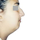 Before Lifting the tip of the nose