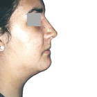 After Lifting the tip of the nose