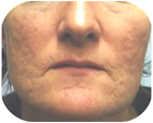 Before Deep Chemical Peel