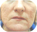 After Deep Chemical Peel