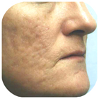 Before Deep Chemical Peel