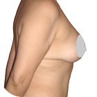 After Breast Lift