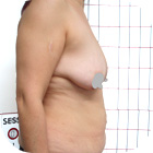 Before Breast Lift