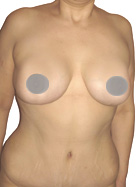 After Breast Lift