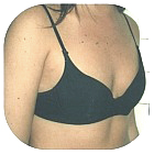 Before Breast Implant