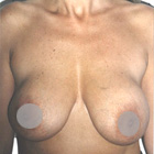 Before Breast Lift