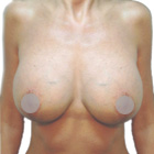 After Breast Lift