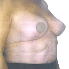 After Breast Lift