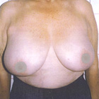 Before Breast Lift