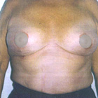 After Breast Lift