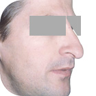 Before Lifting the tip of the nose