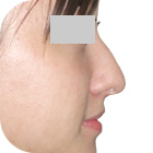 Before Lifting the tip of the nose