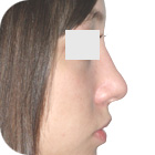 After Lifting the tip of the nose