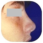 After Rhinoplasty