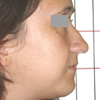 Before Rhinoplasty