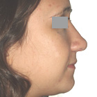 After Rhinoplasty