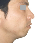 Before Lifting the tip of the nose
