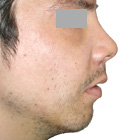 After Lifting the tip of the nose