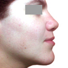 After Lifting the tip of the nose