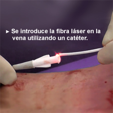 varicoza foluxie laser pre laser)